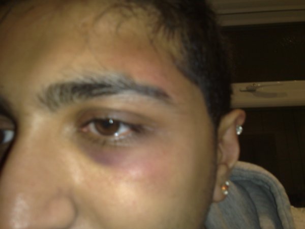 Beaten Up After Xmas Party