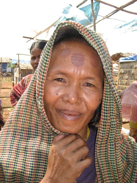 Woman with cupping marks