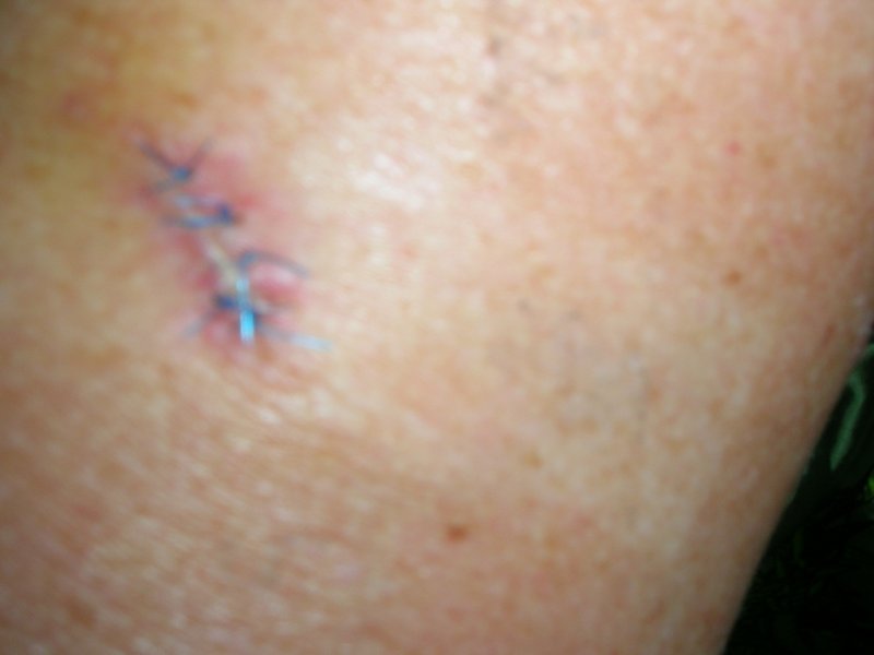 Blue stitches in my arm. Cute ha?