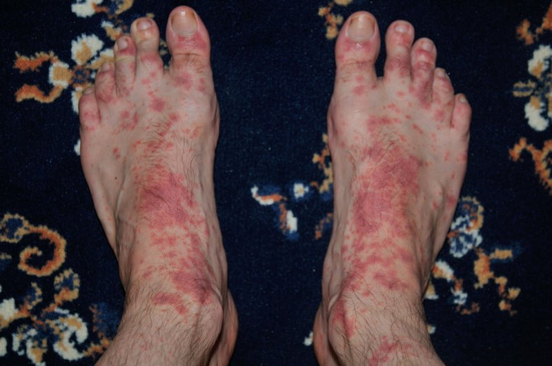 This doesn't look good - spots on my feet in Myanmar
