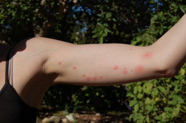 The mosquitos loves Tess. =(