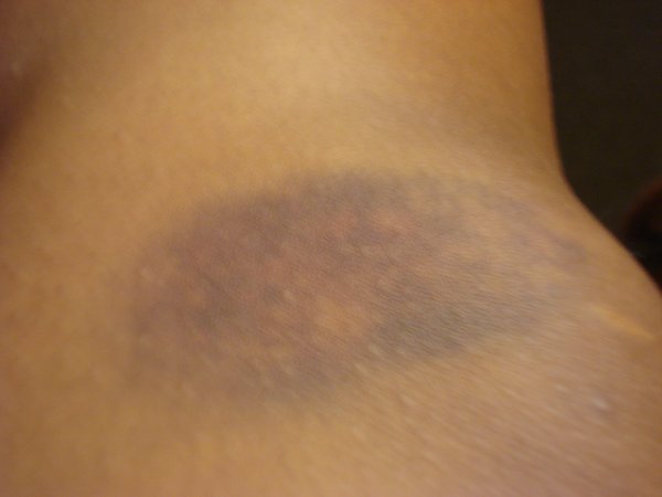 Knee bruise