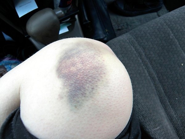 What Hitting an Icy Hill at 30MPH Does to Your Knee...