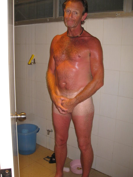 Dave with sunburn!!