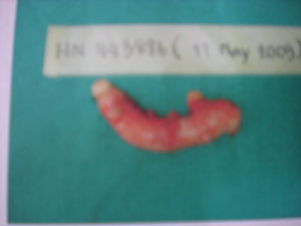 My Appendix!!!