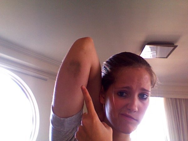 Bruise from rafting