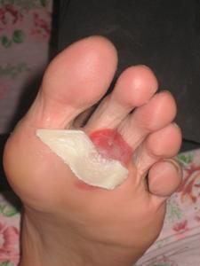 Chris's Downhill blisters