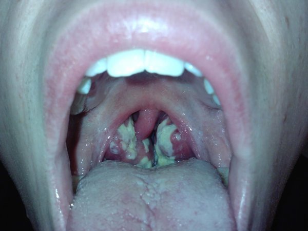 Tonsils at their worst...