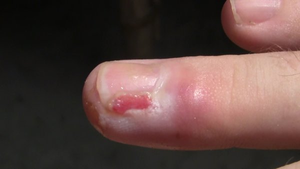 Infected fingers