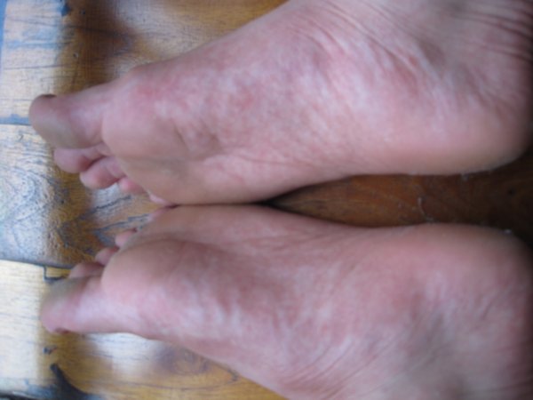 Dengue Rash Feet