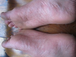 Dengue Rash Feet