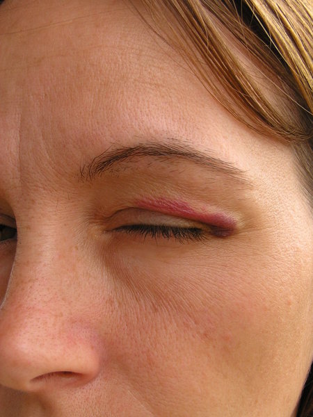 Robin's Eye injury
