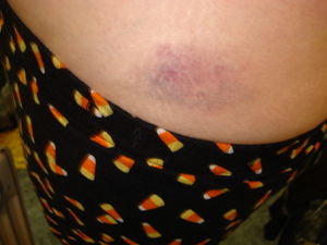 My bruise!