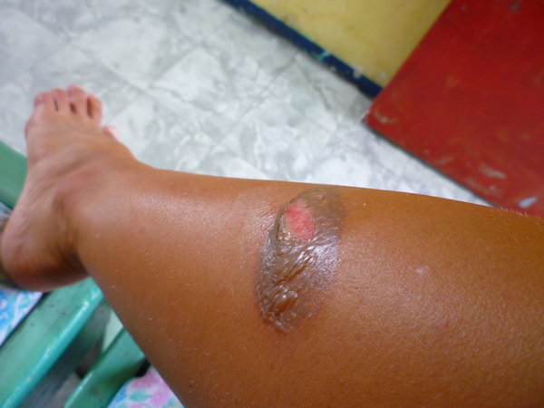 Prt 2: My burnt leg