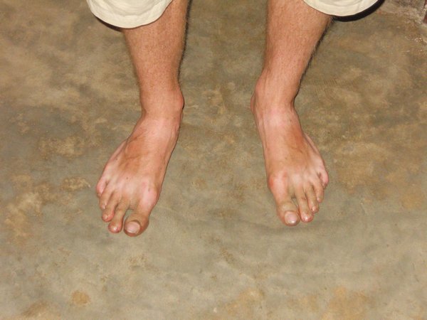 frodo toes