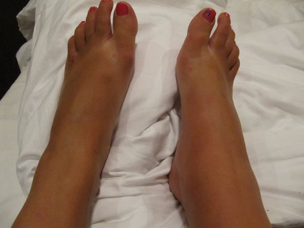 Swollen Ankle!
