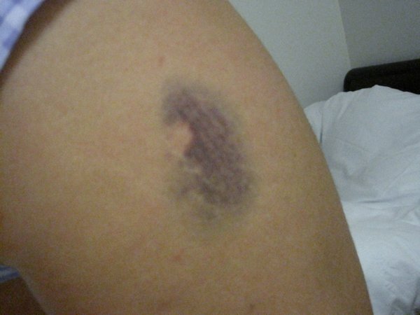 my bruise