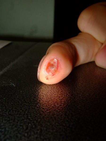 blutiger Finger