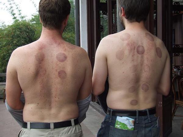 Brendan and Gavin after cupping (Brendan on right).
