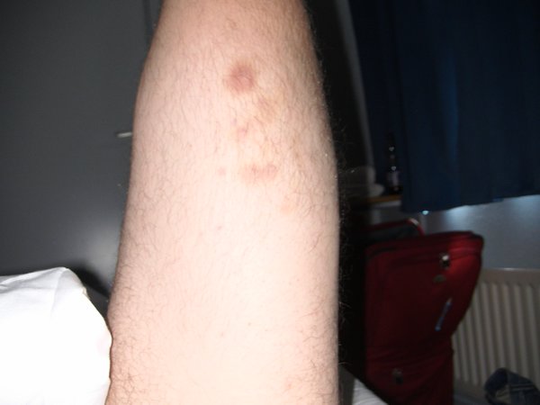 Bruises on leg after Dublin