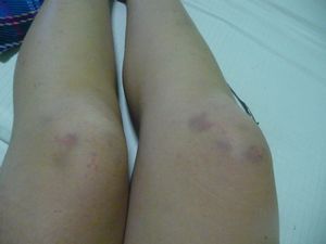My knees after day 1