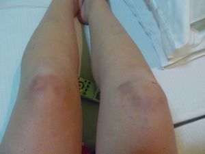 Bruises day 2