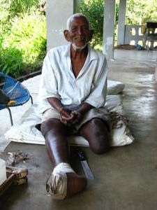 One of the original leprosy patients