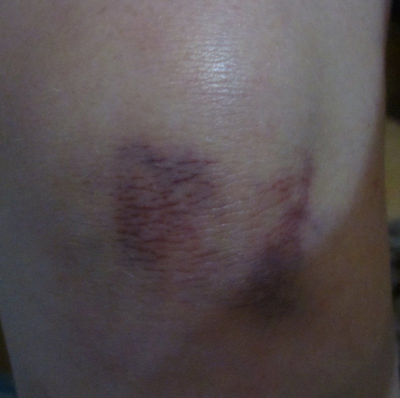 Bruise Shot 2