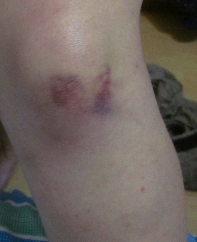Bruise Shot 3