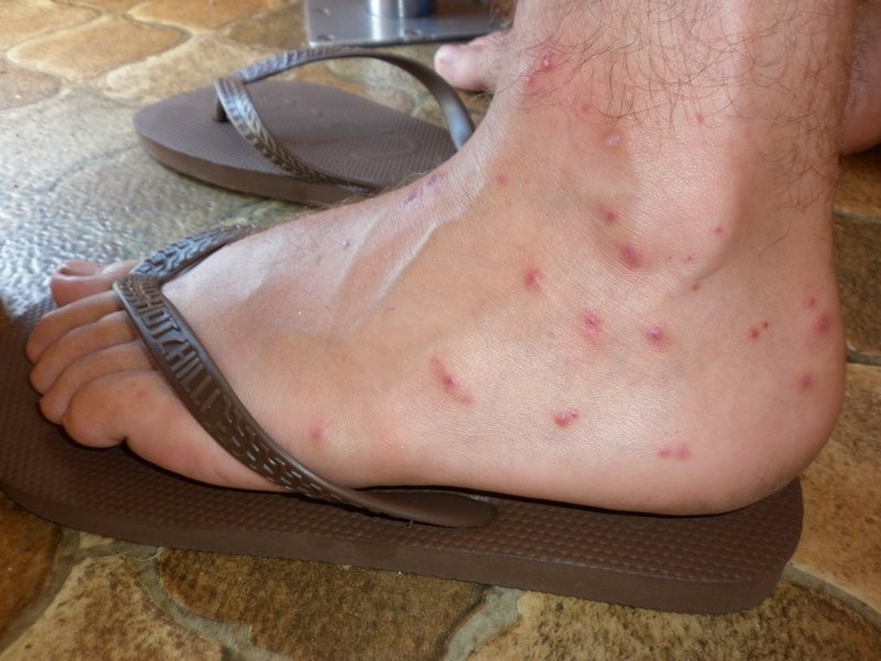 some of the sand fly bites... ouch!