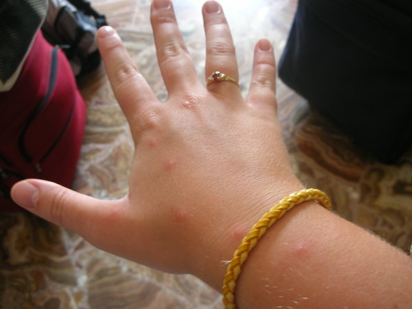 My bug-bitten hand