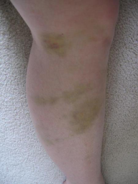 Bruise - Day 4