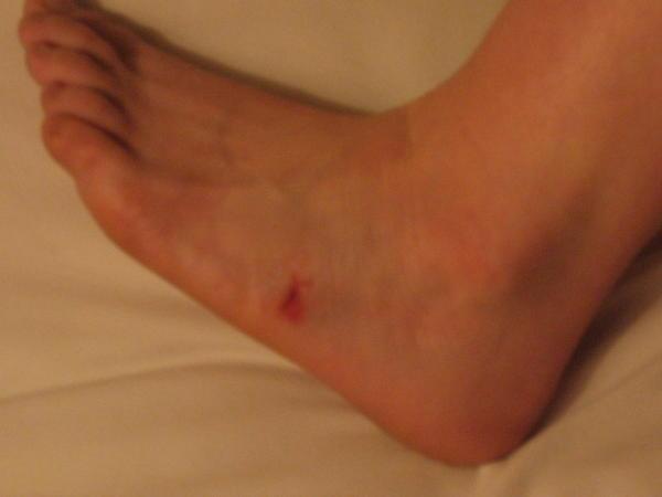 Flip-Flop Injury