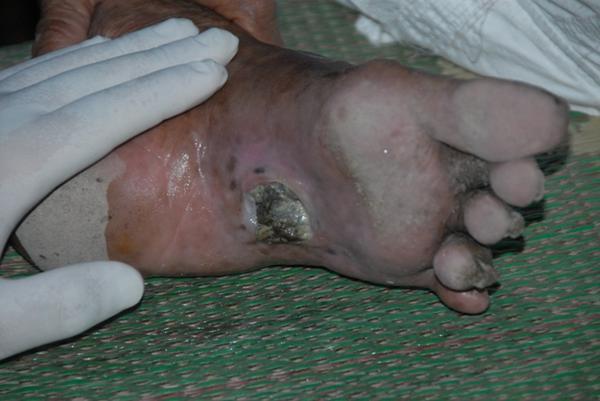 Injured Foot