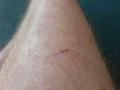 My hiking scars