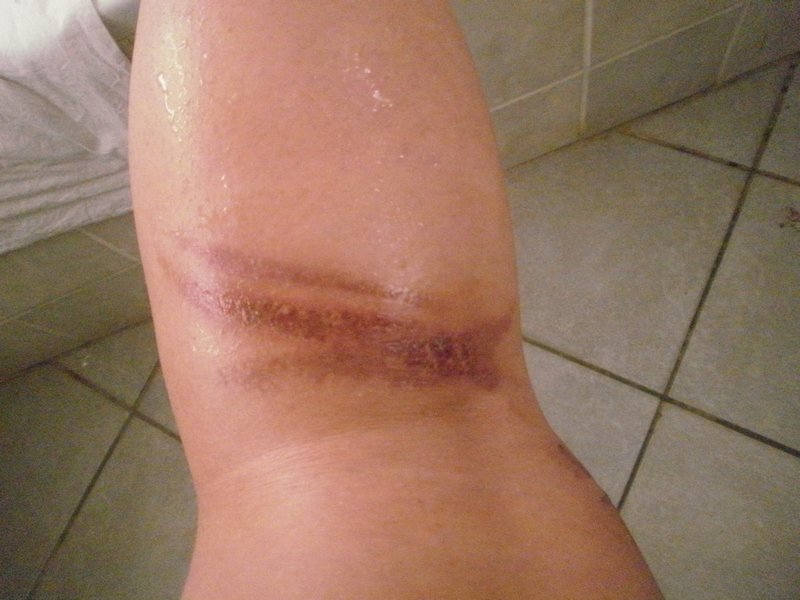 My leg after a week