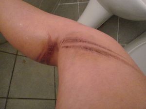 My leg after a week