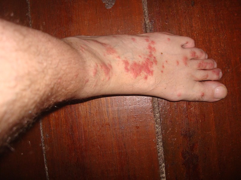 My foot with the bites