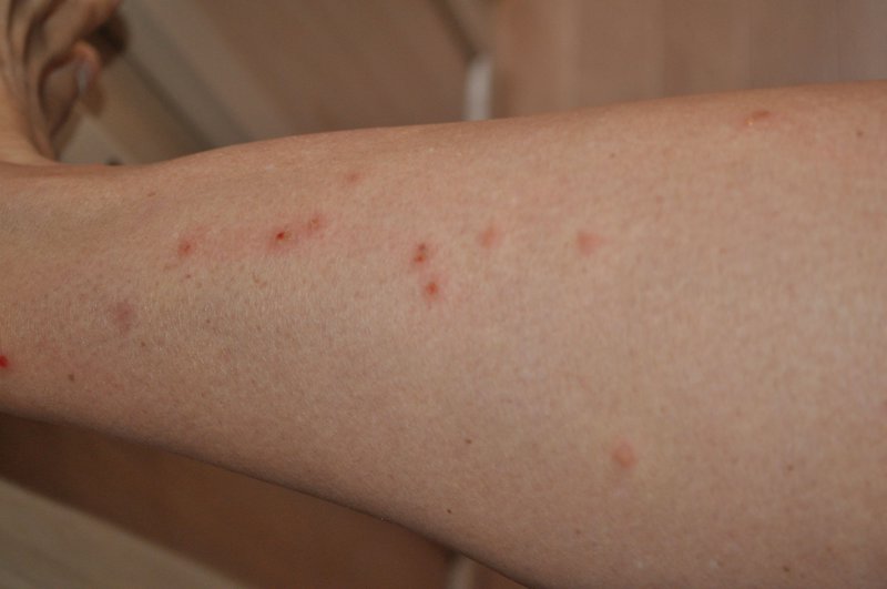17. The first lot of bites, and yes, I had doused myself with spray!