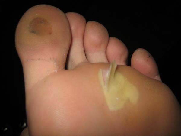 A nice picture of the blisters on me feet 