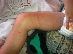 Coogee (battle scars - jellyfish sting) (3)