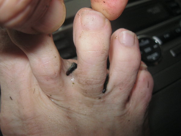 Leeches between toes...omg!!