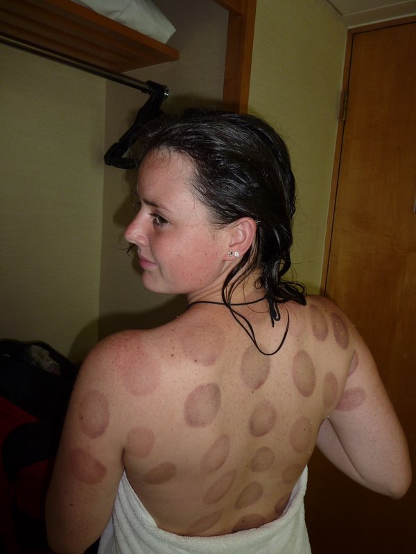 My back after the hot cupping