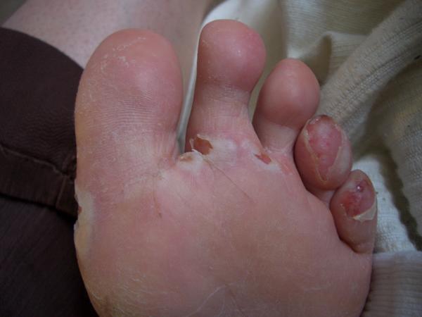 Some Blisters!