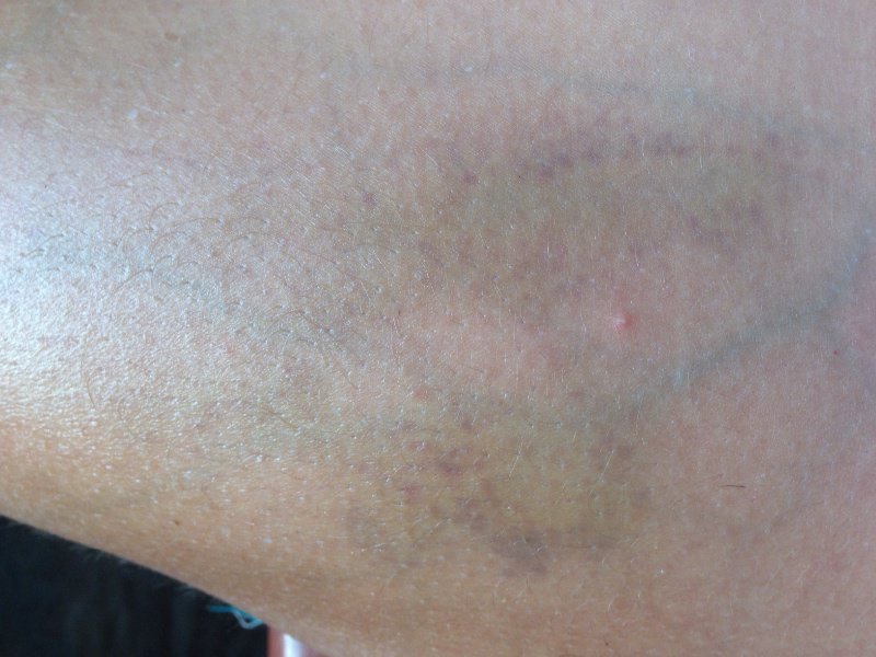 The bruise on my thigh