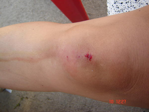 My sore knee.... It was worse than it looks!!
