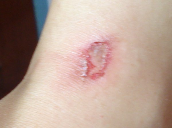 Rinna's burn from the Full Moon Party!!
