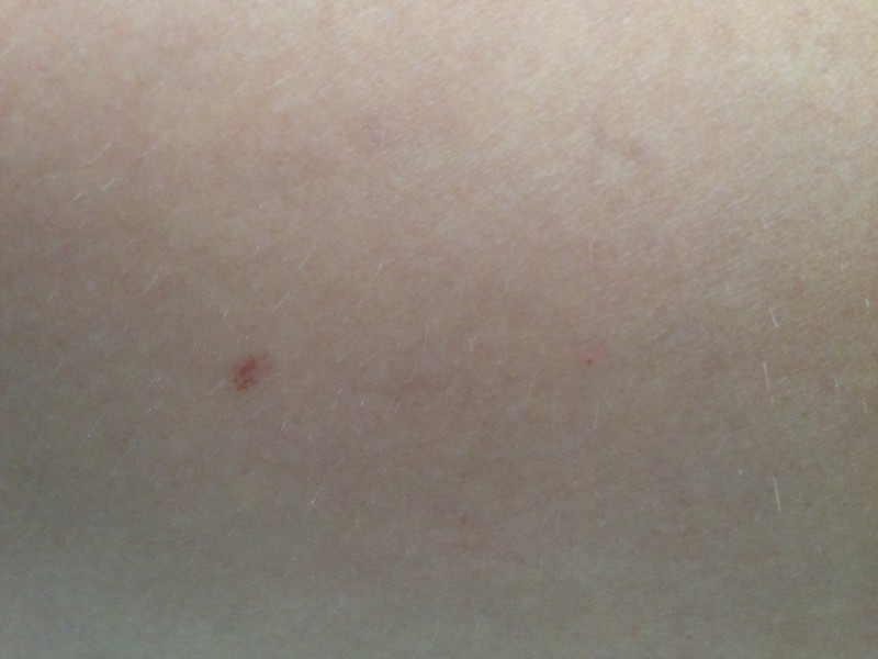 My puncture wound 