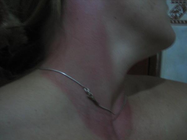 My Sunburn - Ouch