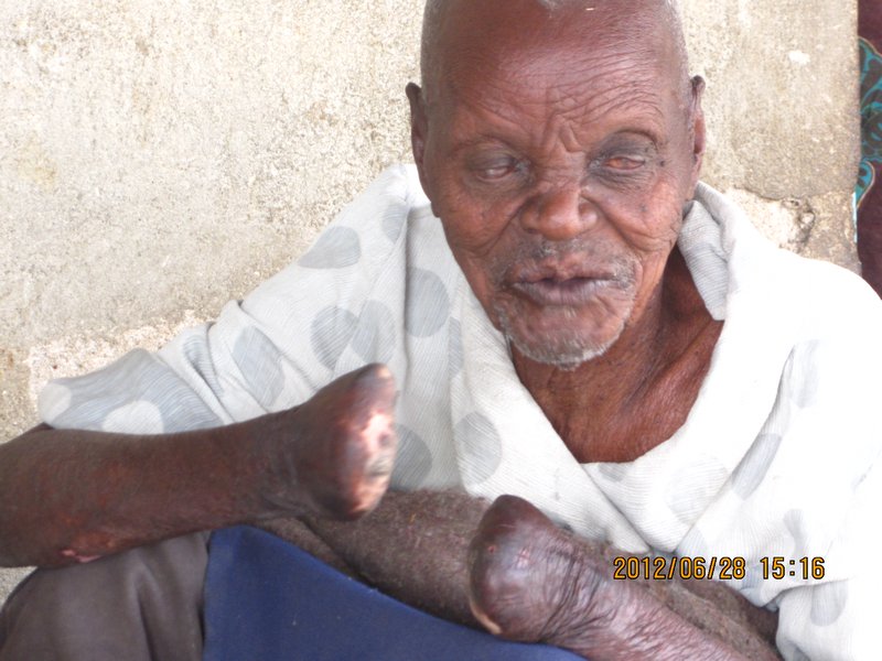 Leprosy Patient at Hombolo